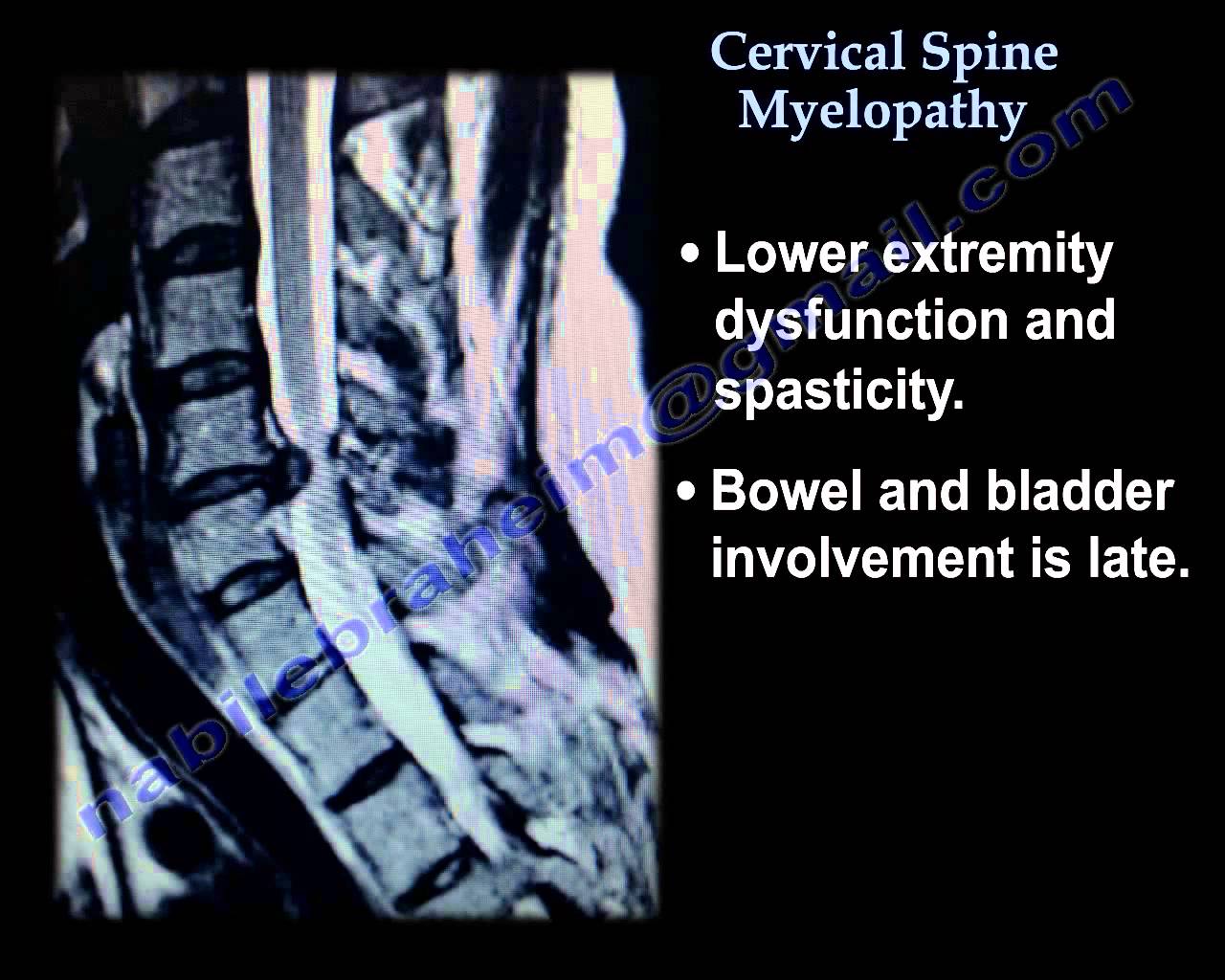Cervical Myelopathy: We Wanted to Know
